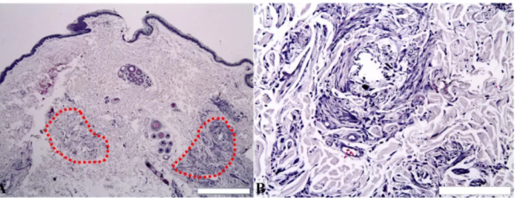 Fig. 2. Histopathologic appearance of the biopsy in inguinal region. (A) Atrophy of epidermis and skin adnexa with marked deposition of calcium at the sites of crystal formation and along degenerating collagen fibers (dotted line)