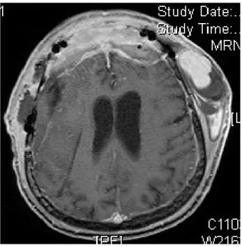 Fig. 1. Axial MRI demonstrating flow voids in the region of  the STA.