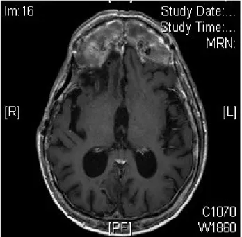 Fig. 4. MRI one year after coiling demonstrating no recurrence  of the STA pseudoaneurysm.