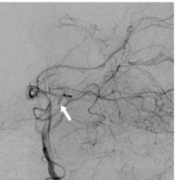 Fig. 4. Case 2. Follow up digital subtraction angiography (DSA) acquired 28 days after double stenting