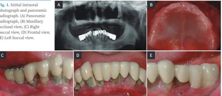 Fig. 1. Initial intraoral  photograph and panoramic  radiograph. (A) Panoramic  radiograph, (B) Maxillary  occlusal view, (C) Right  buccal view, (D) Frontal view,  (E) Left buccal view.