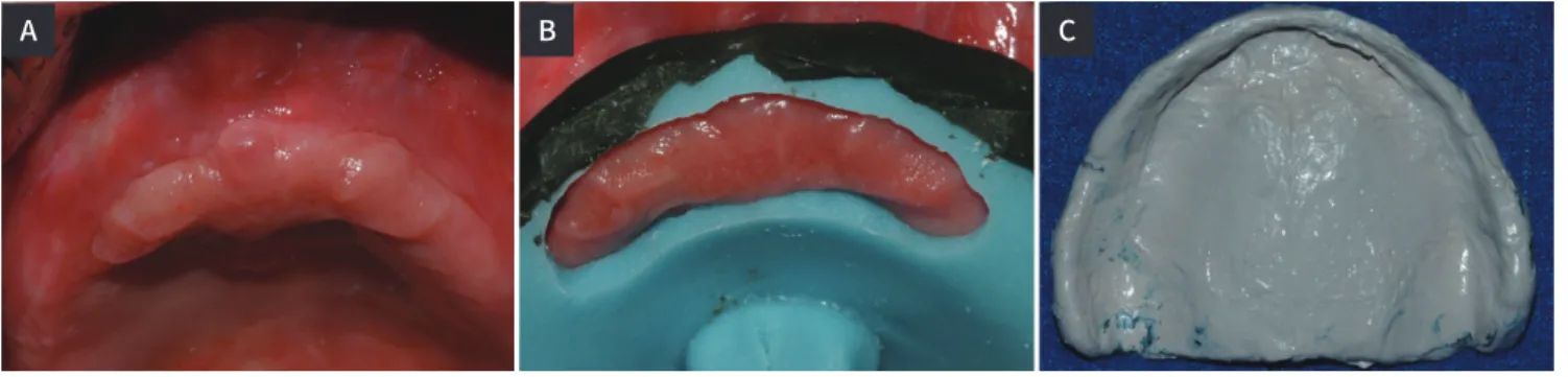 Fig. 2. (A) Flabby tissue on maxillary anterior area, (B) Individual tray with open window technique, (C) Final impression.