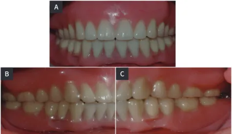 Fig. 5. (A) Milled bar, (B) Friction pin  attached to mesostructure - inner  surface of overdenture.