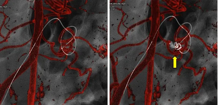 Fig. 3. Even though superselection of AICA orifice was not difficult, aneurysm selection was very difficult due to the tortuous course  of  AICA  and  relatively  small  diameter  of  AICA  to  accommodate  microcatheter