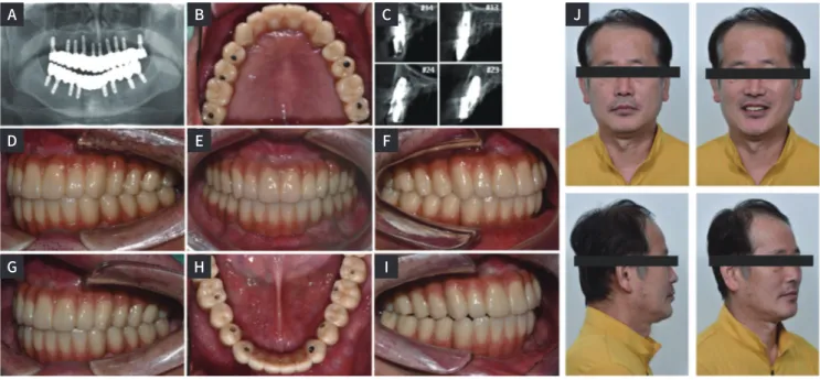 Fig. 7. Post-operative intraoral photograph (B, D-I), extraoral photograph (J), radiographic evaluation (A, C)
