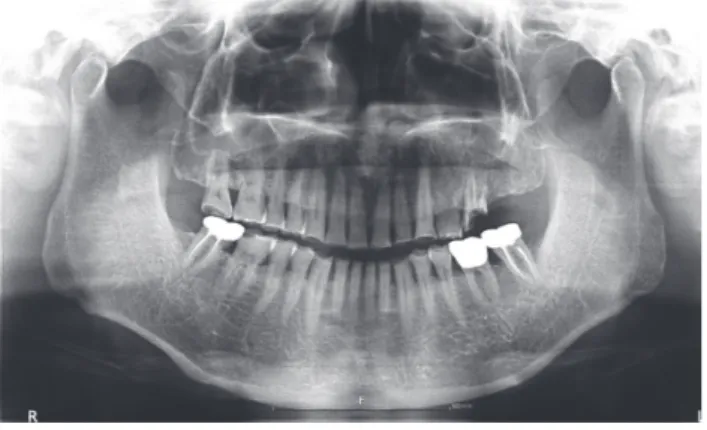 Fig. 1. Panoramic radiographic at the initial visit.