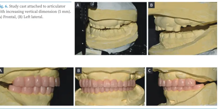 Fig. 7. Diagnostic wax-up. (A) Right lateral, (B) Frontal, (C) Left lateral.