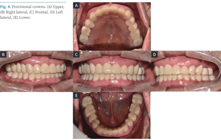 Fig. 8. Provisional crowns. (A) Upper,  (B) Right lateral, (C) Frontal, (D) Left  lateral, (E) Lower.