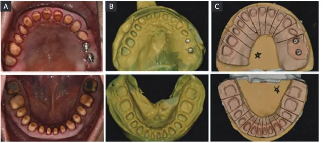 Fig. 10. Design of definitive prostheses using double scanning procedure. (A) Upper, (B) Frontal, (C) Lower.