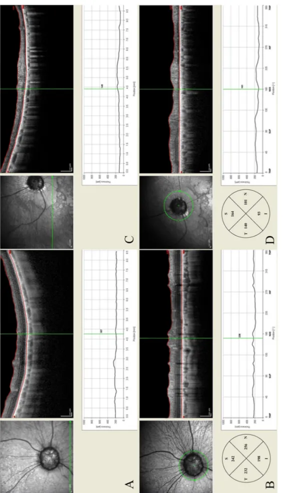 Fig. 4. OCT scan images. A and B: a 6-year-old normal Shih Tzu. C and D: a 6-year-old Poodle with retinal degeneration in the study