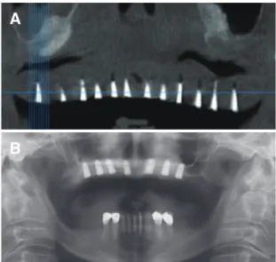 Fig. 1. (A) Panoramic radiograph at first visit, (B) Profile of patient at rest, (C) Maxillary occlusal view.