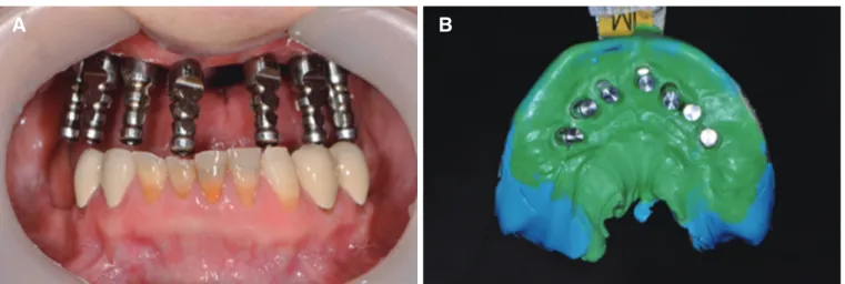 Fig. 5. (A) Customized implant abutments and milled provisional restorations, (B) Intraoral frontal view with customized implant abutments, (C) Intraoral fron- fron-tal view with provisional restorations in place.