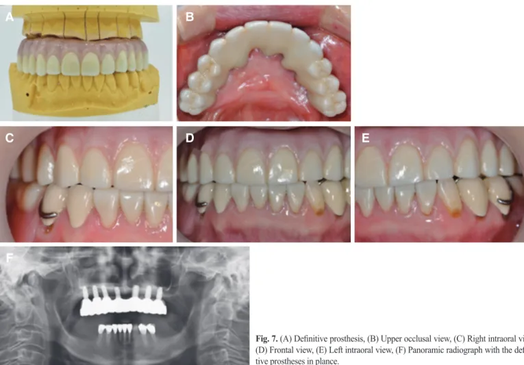 Fig. 7. (A) Definitive prosthesis, (B) Upper occlusal view, (C) Right intraoral view,  (D) Frontal view, (E) Left intraoral view, (F) Panoramic radiograph with the  defini-tive prostheses in plance.