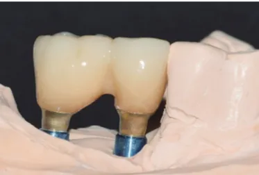 Fig. 1. Radiographic view of implant placed in the mandibular right poste-