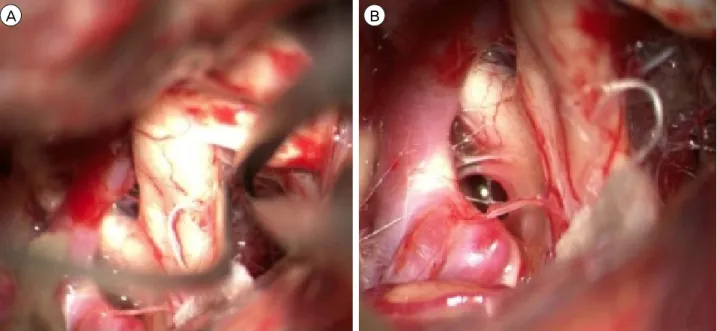 Fig. 3. View from right pterional craniotomy shows an infraoptic A1 segment. The ACA projects medially underneath the optic nerve  and arises anterior to the optic chiasm (A) in the pre-chiasmatic space (B)