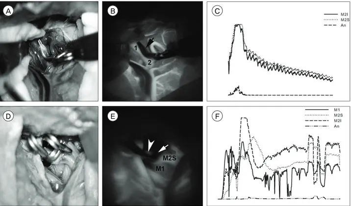Fig. 2. Example of good data quality (A, B, and C) and of poor quality (D, E, and F). A and D are photographs of operative  fields, B and E are averaged images of serial captures of indocyanine green (ICG) videoangiography (VA), C and F are graphs