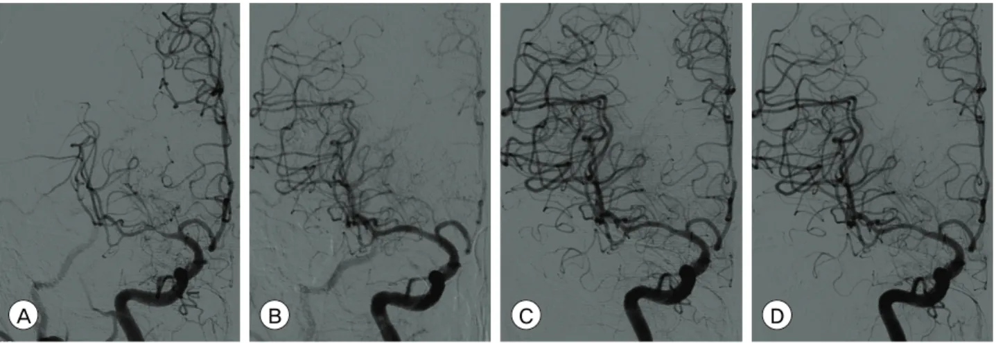 Fig. 1. Catheter angiograms of a 66-year-old male patient who presented with repeated transient ischemic attacks of left arm  weakness