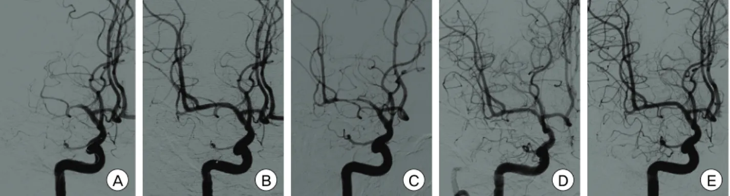 Fig. 3. Catheter angiograms of a 47-year-old male patient who presented with right MCA borderzone infarct