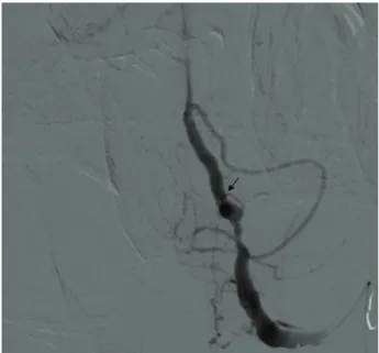 Fig. 3. Left vertebral angiogram shows a dissecting aneurysm. 