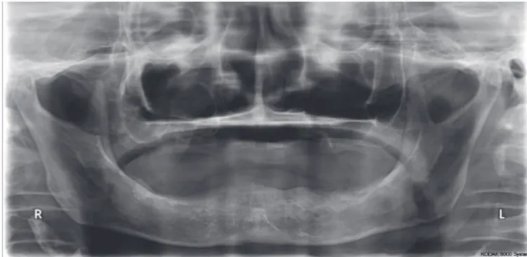 Fig. 1. Panoramic radiograph (Pre-extraction). Fig. 2. Panoramic radiograph (Post-extraction).