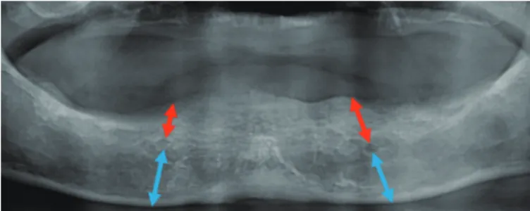 Fig. 4. Extent of mandibular residual ridge based on location of mental foramen.