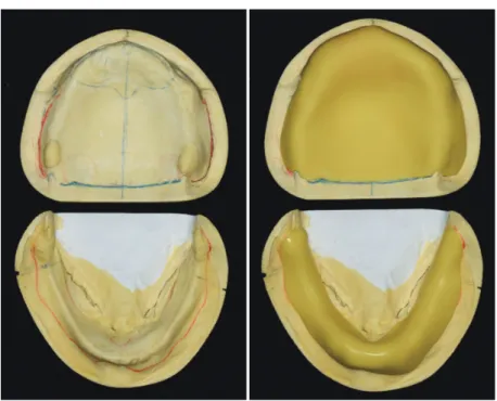 Fig. 11. Mark of anatomical landmark and fabrication of individual tray.
