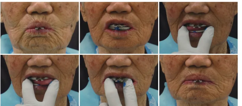 Fig. 14. Exercise for closed-mouth definitive impression.