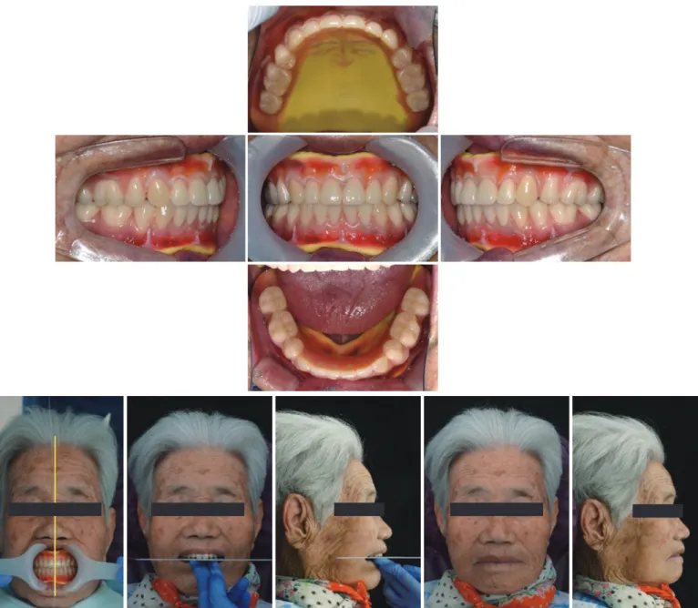 Fig. 20. Trial denture try-in.