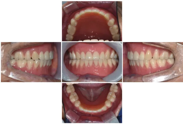Fig. 22. Definitive denture delivery. 고찰 완전무치악 환자에서 잔존치조제는 총의치의 유지 및 안정에  매우  중요한 요소이다