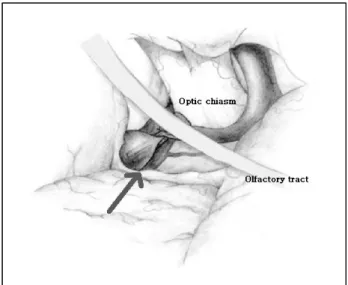 Fig. 1. Schematic drawing of subolfactory approach; dissection  of olfactory tract and suck out of rectus gyrus inferomedial of  olfactory tract allows no need for retractor and direct  visual-ization of high-positioned anterior communicating artery  aneur