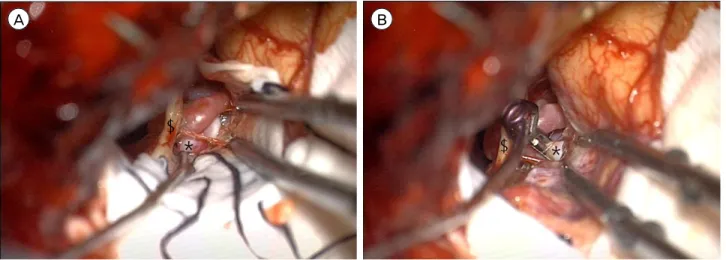Fig. 2. (A) Operative photo of subolfactory approach: direct visualization of high-positioned anterior communicating artery aneurysm  with minimal retraction with no retractor