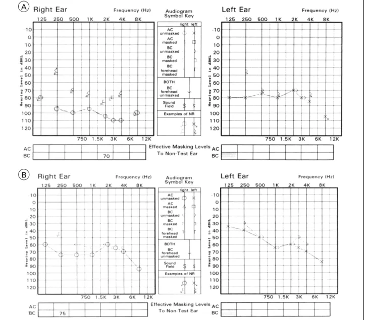 Fig. 1. Initial pure tone audiometry (A) shows bilateral sensorineural hearing loss and follow-up pure tone audiometry (B) 2 weeks  after symptom onset reveals improvement of hearing.