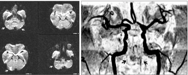 Fig. 3. Transfemoral cerebral angiography shows occlusion of the right proximal vertebral artery and basilar artery (A) and severe  stenosis of the left distal vertebral artery (B)