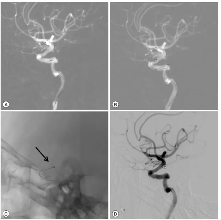 Fig. 1. A case in which the Neuroform stent delivery system failed to advance into the Renegade microcatheter