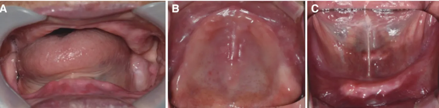 Fig. 3. Preliminary impression taking. (A) Frame Cut Back Tray, (B) Mandibular alginate impression, (C) Maxillary alginate impression.