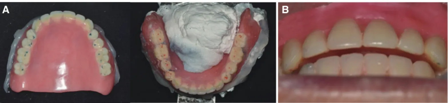 Fig. 11. (A) Clinical remounting, (B) Overjet.