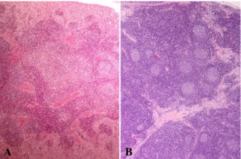 Fig. 3.  Lymph node. Note multinucleated giant cells (arrows). (A) Normal lymph node. (B) H&amp;E Stain, ×100.
