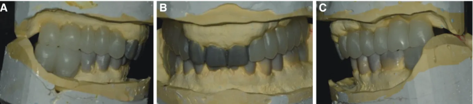 Fig. 3. Diagnostic wax up model with new occlusal vertical dimension. (A) Right lateral view, (B) Frontal view, (C) Left lateral view.