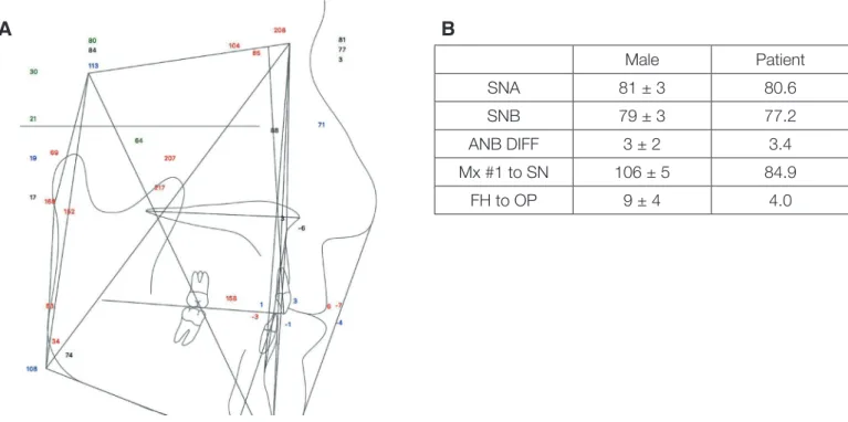 Fig. 5. Cephalometric analysis (A) Lateral Cephalography (B) Comparison of the cephalometric analysis on the patient and the male