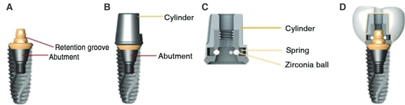 Fig. 1. Schematic Design of EZ crown system (Samwon DMP, Yangsan, Korea). (A) Abutment connected to implant fixture, (B) Cylinder connected to abut- abut-ment, (C) Cylinder inner structure, (D) All components of EZ crown system connected.