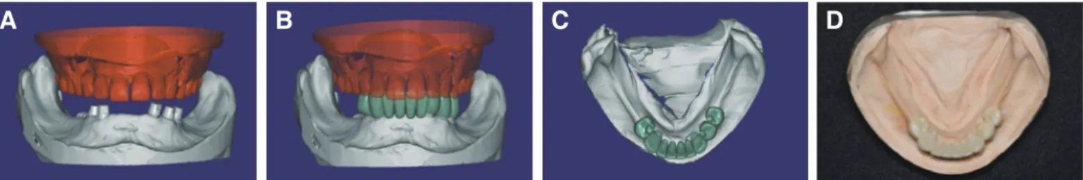 Fig. 8. Computer-aided design for zirconia implant surveyed prosthesis. (A) Frontal view, (B) Frontal view of implant surveyed prosthesis design, (C) Occlusal  view of implant surveyed prosthesis design, (D) Occlusal view of implant surveyed prosthesis on 