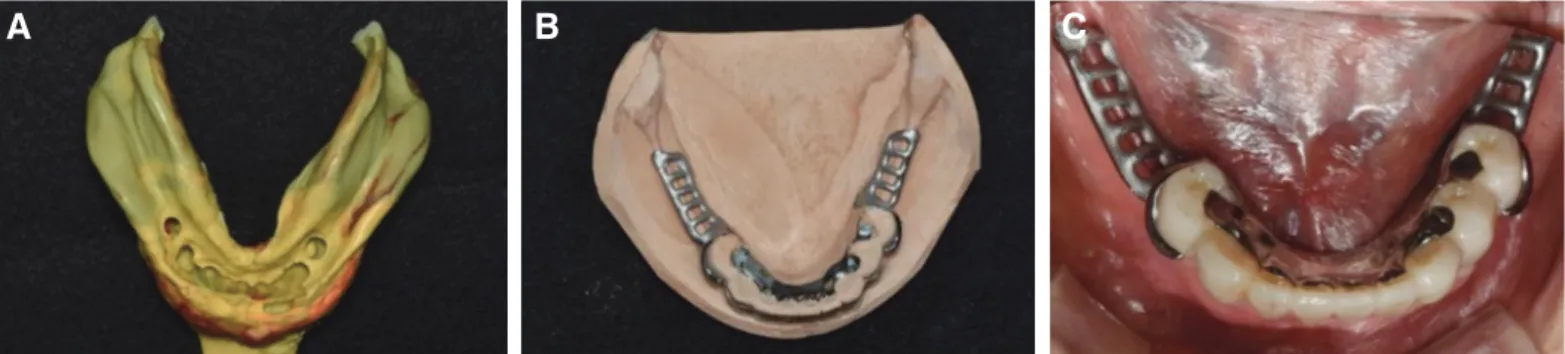 Fig. 11. Fabrication of metal framework. (A) Final impression for removable partial denture, (B) Metal framework on working model, (C) Intraoral try-in of  metal framework.