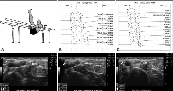 Fig. 1. Ulnar neuropathy at the midarm after exercising on parallel bars. A: The midarm support position on parallel bars (arrow)