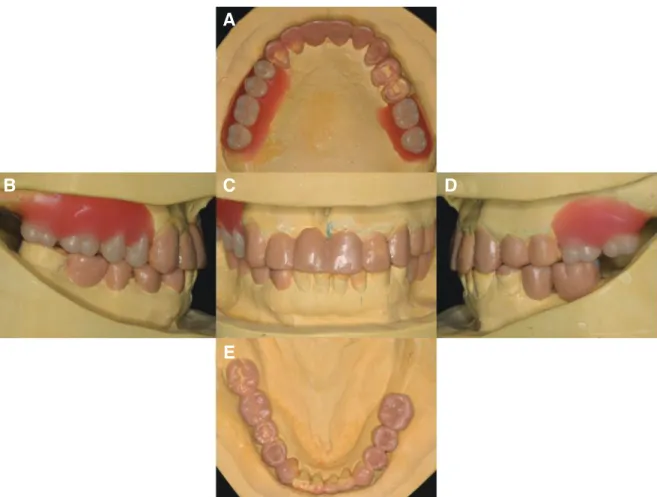 Fig. 3. Diagnostic wax up model with new occlusal vertical dimension. (A) Maxillary occlusal view, (B) Right lateral view, (C) Frontal view, (D) Left lateral  view, (E) Mandibular occlusal view.