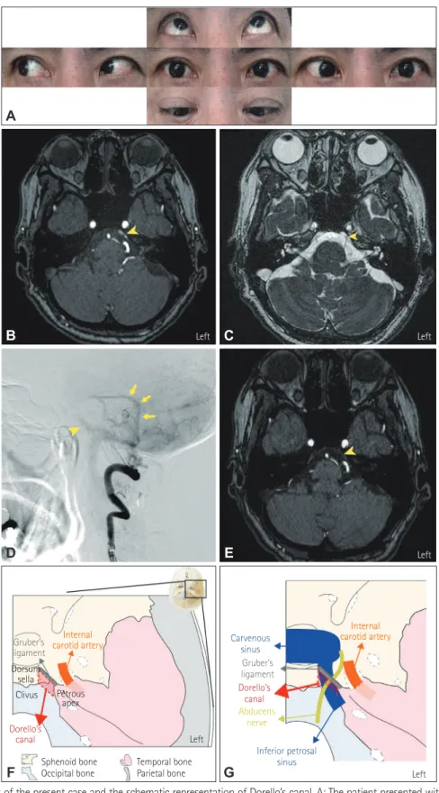Fig. 1. Imaging findings of the present case and the schematic representation of Dorello’s canal