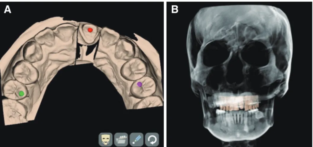 Fig. 4. Image merging of computed tomography and intraoral scan images using remaining teeth