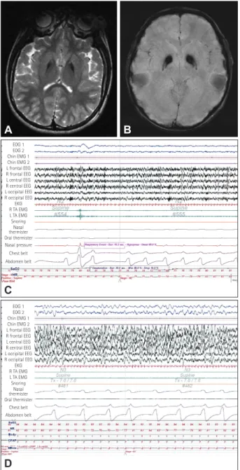 Fig. 1. Magnetic resonance imaging and polysomnography features  of the patient. T2-weighted (A) and T2* susceptibility-weighted  im-ages showing a hyperintense center with a dense hypointense rim  (eye-of-tiger sign) (B)