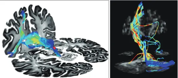 Fig. 2. Frontal-habenula-cerebellar and frontal-cerebellar tracts. The long fiber pathway connecting the frontal cortex via the habenula to the  cerebellum (left) and the frontal-cerebellar tracts (right) were tracked using 3-T, 64-direction diffusion-tens