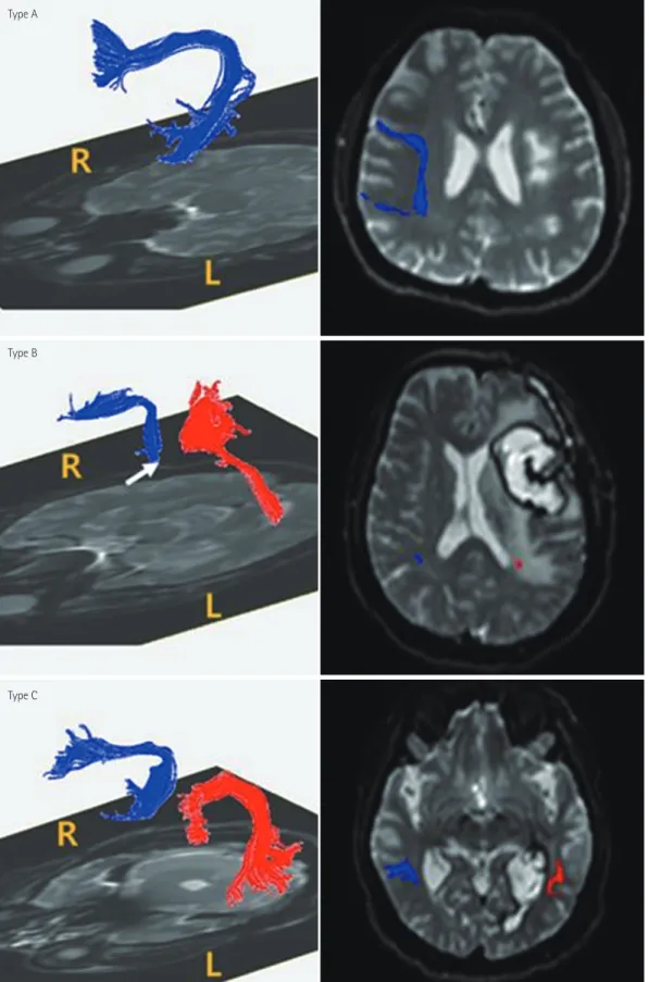 Fig. 4. Three levels of damage to the left AF. DTI of the AF (left column) and T2-weighted magnetic resonance images (right column) show three  types of AF (blue, right AF; red, left AF) categorized according to the severity of damage