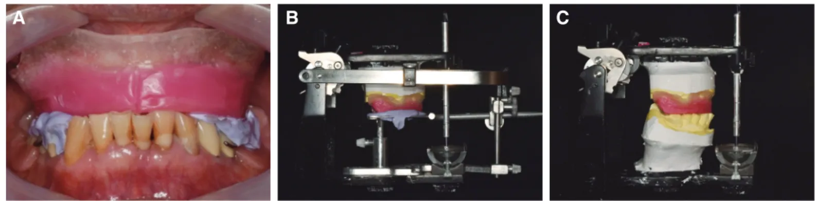 Fig. 5. Model scan. (A) Upper jaw, (B) Lower jaw, (C) Wax rim bite, (D) Aligning both jaws.